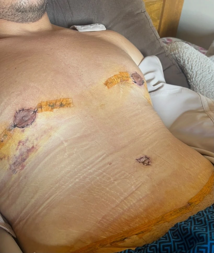 Abdômen com diástase abdominal visível antes do tratamento
