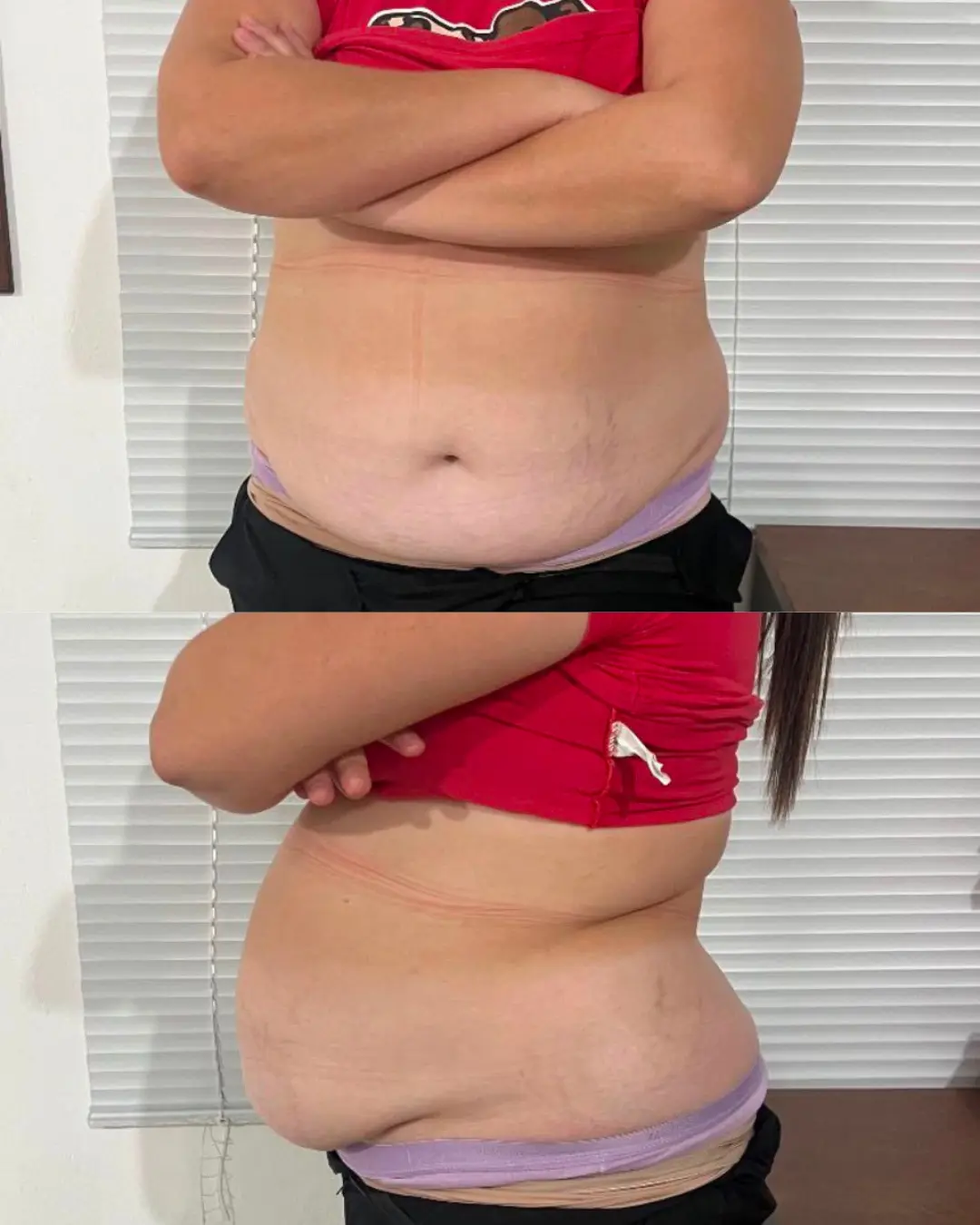 Diástase e flacidez abdominal pós-parto antes do tratamento