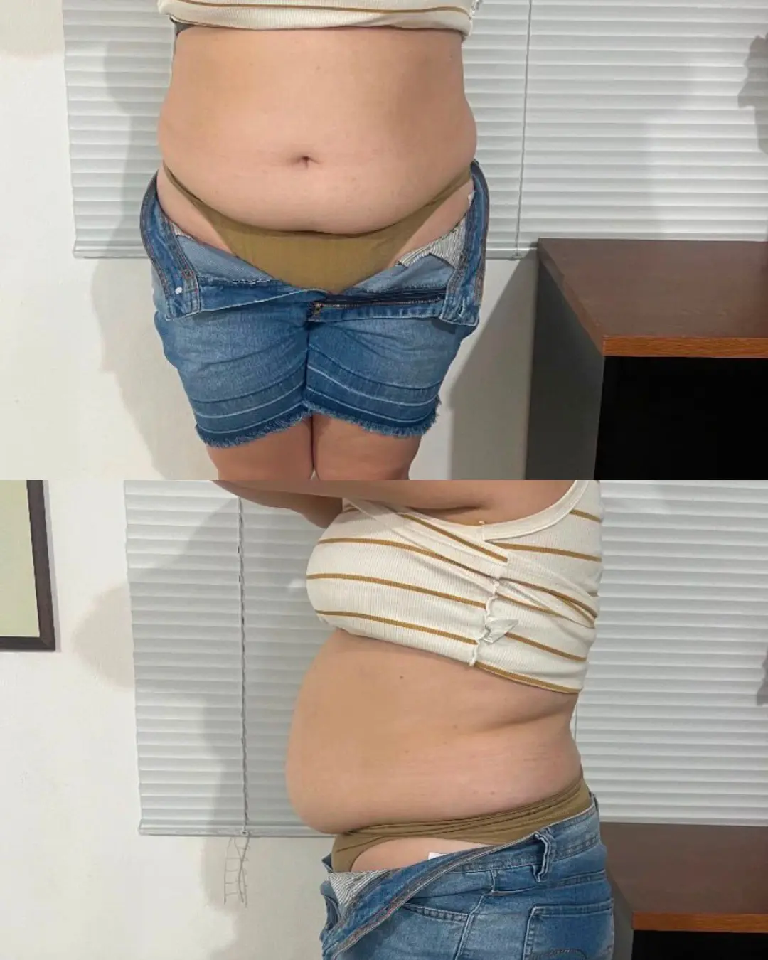 Silhueta pré-tratamento com maior volume abdominal