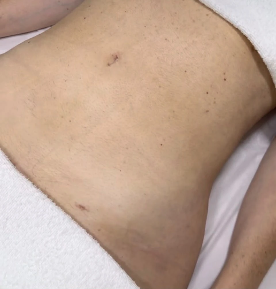 Resultado de recuperação pós-operatória com contorno corporal definido