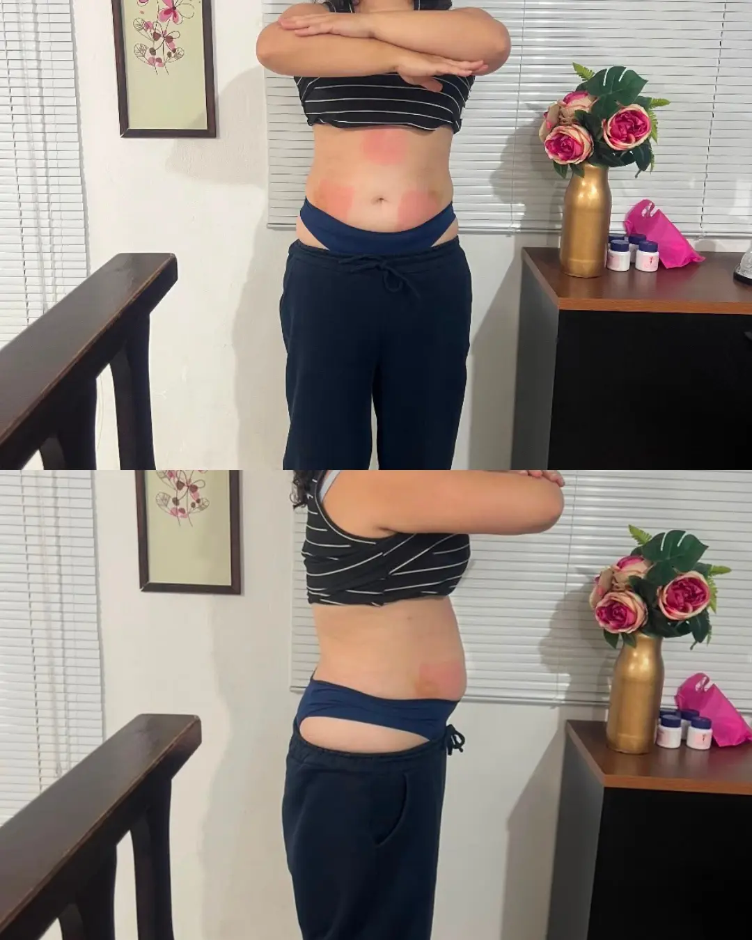 Resultado pós-tratamento de contorno abdominal com silhueta bem definida e 8kg off